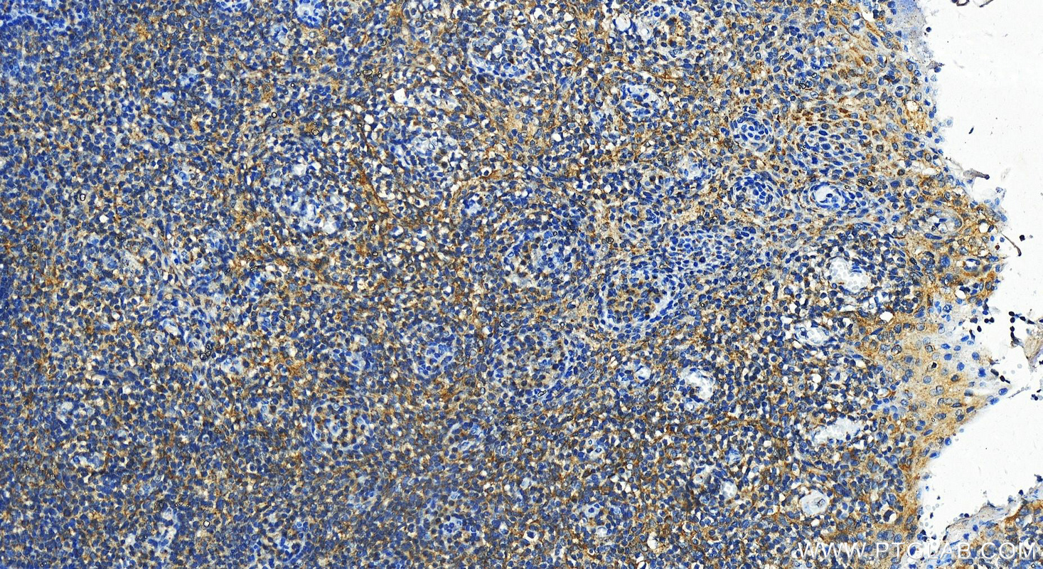 IHC staining of human tonsillitis using 12427-1-AP
