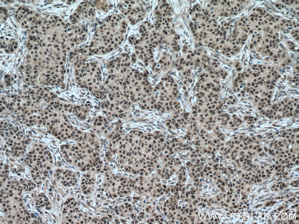 IHC staining of human breast cancer using 12310-1-AP