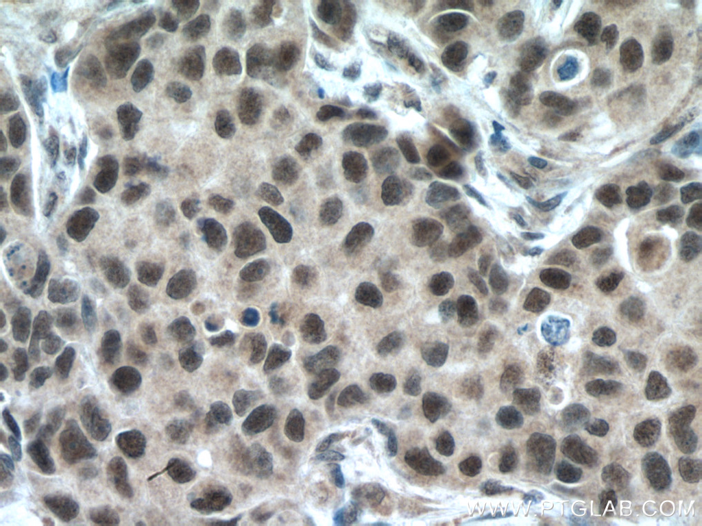 IHC staining of human breast cancer using 12310-1-AP