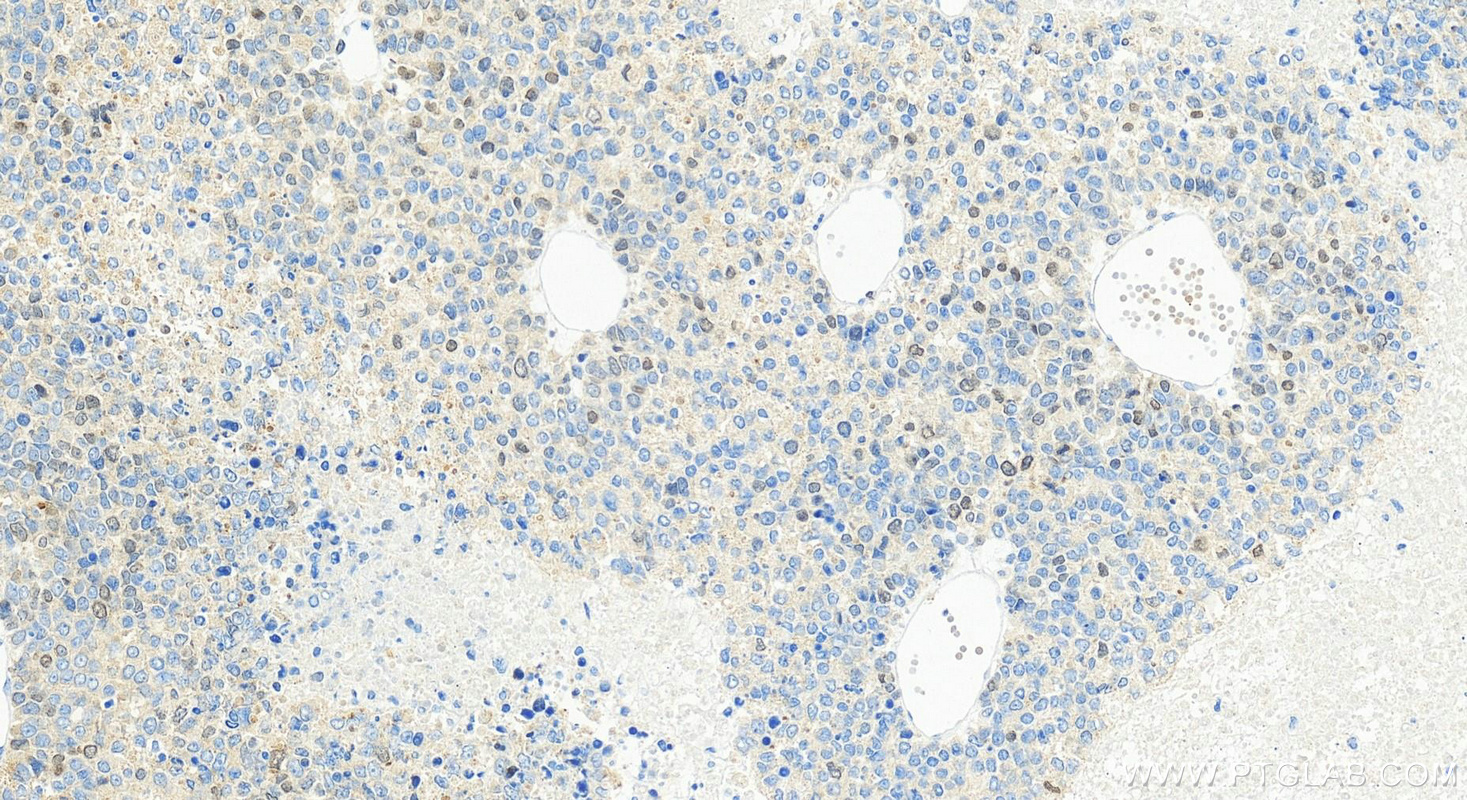 IHC staining of Hepatocellular carcinoma using 86379-1-RR