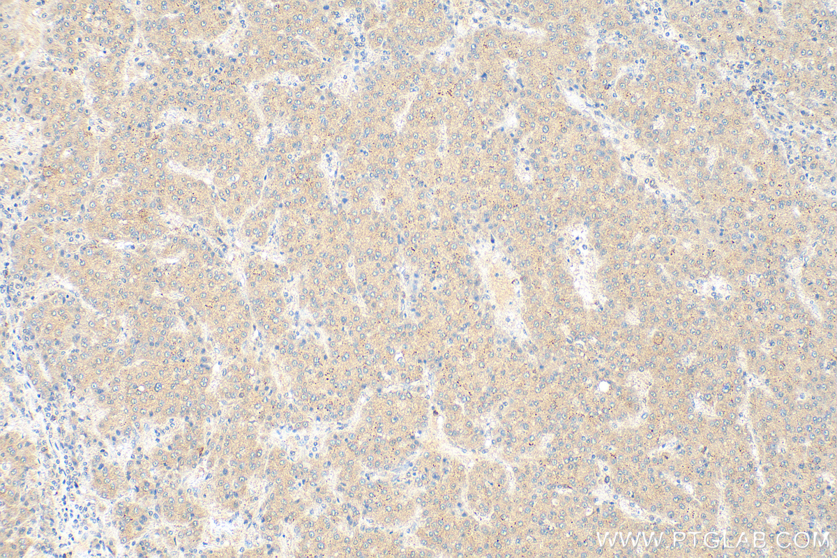 IHC staining of human liver cancer using 15594-1-AP