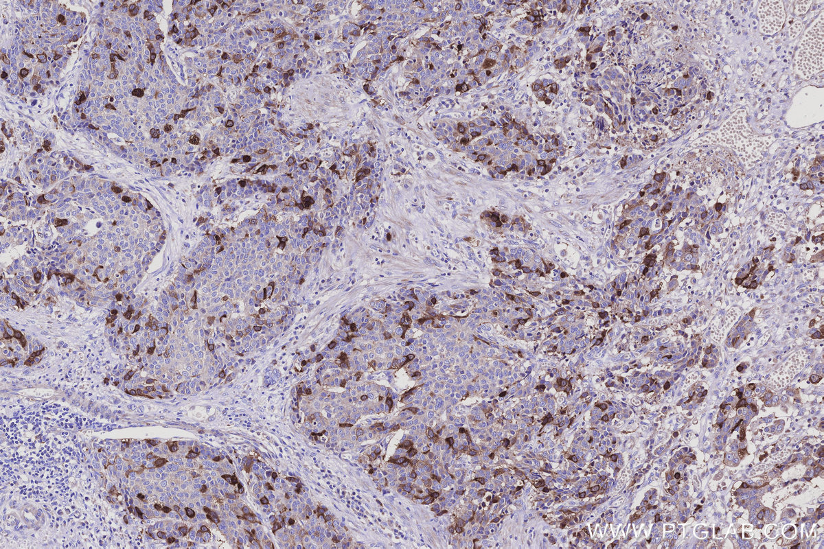 IHC staining of human stomach cancer using 15594-1-AP