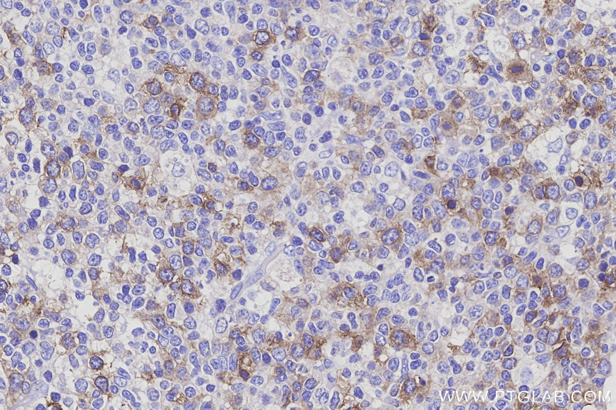 IHC staining of human tonsillitis using 15594-1-AP