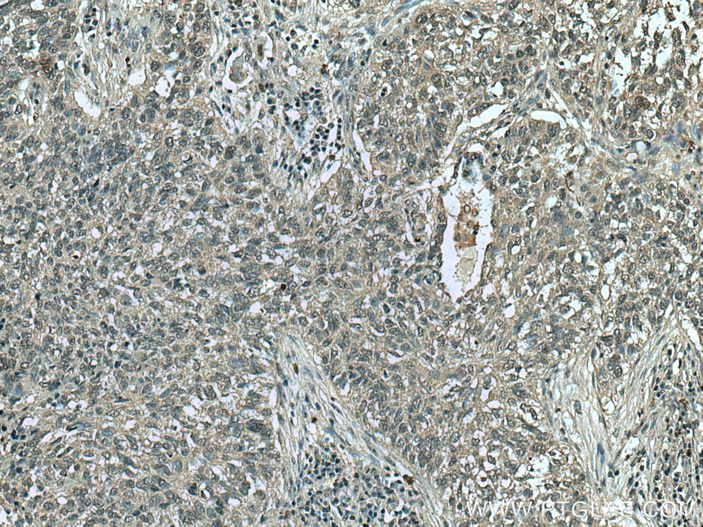 IHC staining of human lung cancer using 67418-1-Ig (same clone as 67418-1-PBS)