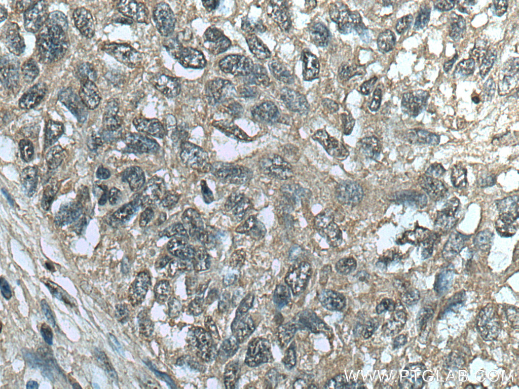 IHC staining of human lung cancer using 67418-1-Ig (same clone as 67418-1-PBS)