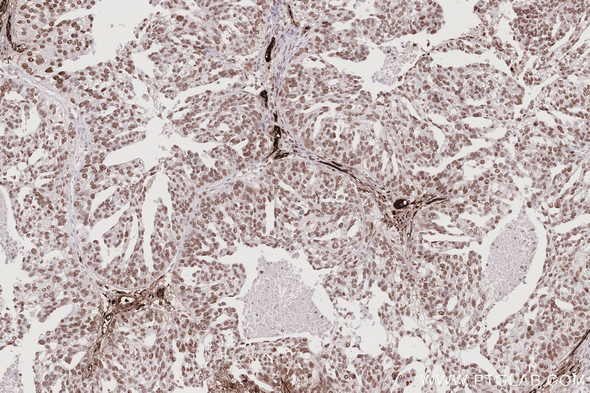 IHC staining of human ovary cancer using 67418-1-Ig