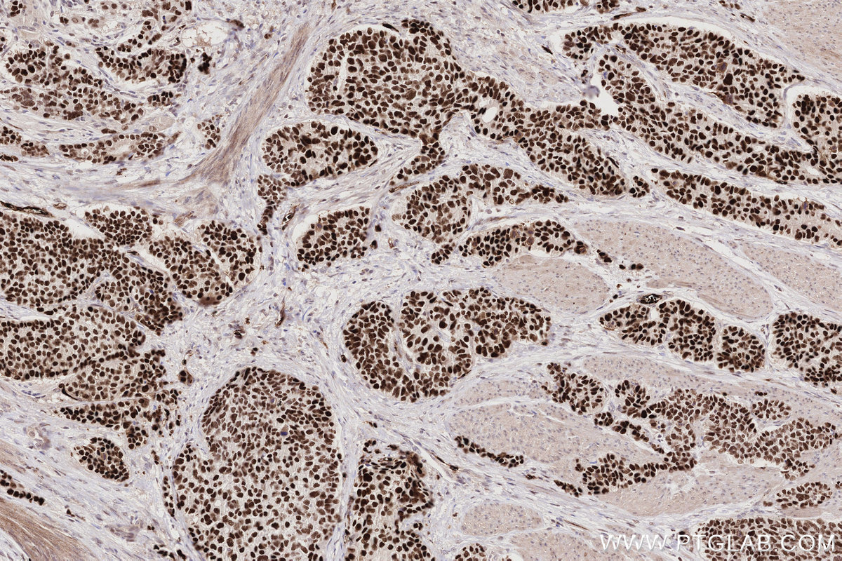 IHC staining of human stomach cancer using 67418-1-Ig