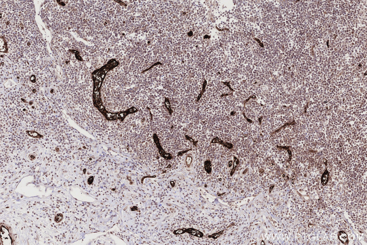 IHC staining of human appendicitis using 67418-1-Ig