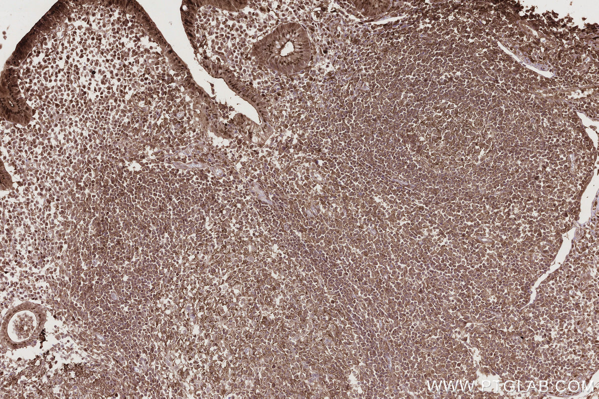 IHC staining of human appendicitis using 83682-4-RR IHC staining of human appendicitis using 83682-4-RR