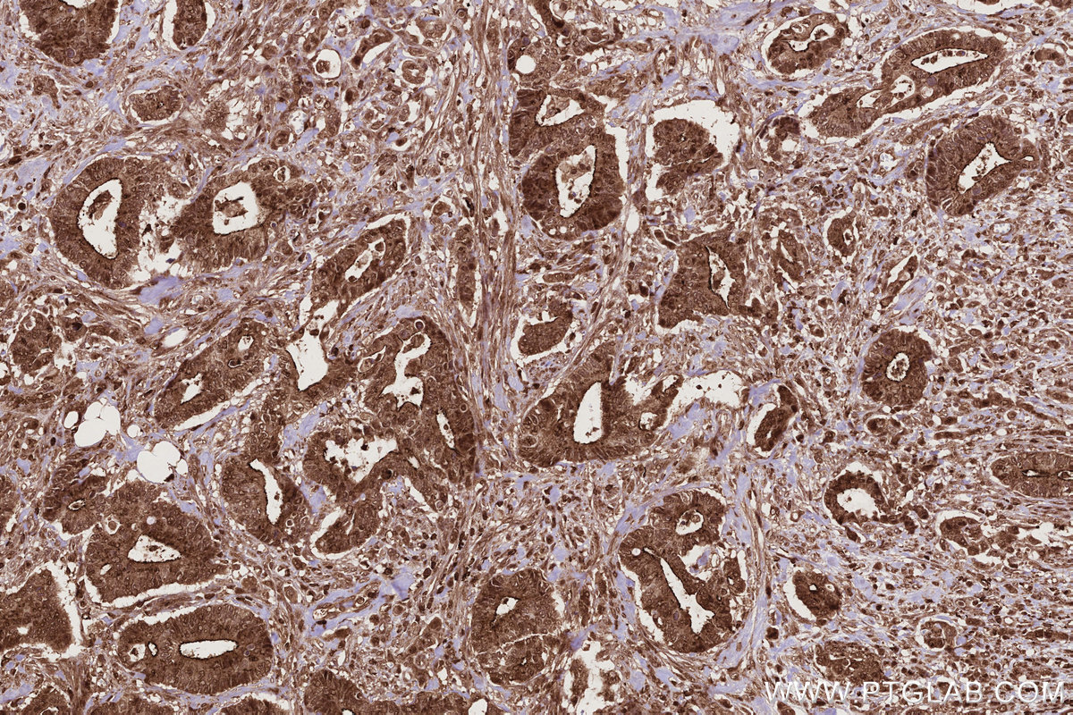 IHC staining of human rectal cancer using 83682-4-RR IHC staining of human rectal cancer using 83682-4-RR