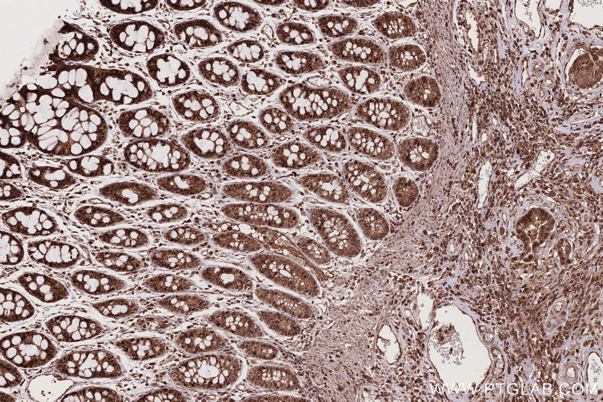 IHC staining of human rectal cancer using 83682-4-RR IHC staining of human rectal cancer using 83682-4-RR