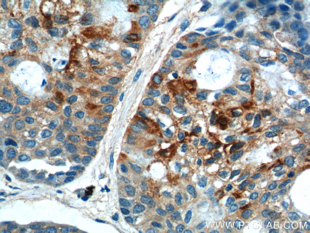 IHC staining of human lung cancer using 12465-1-AP