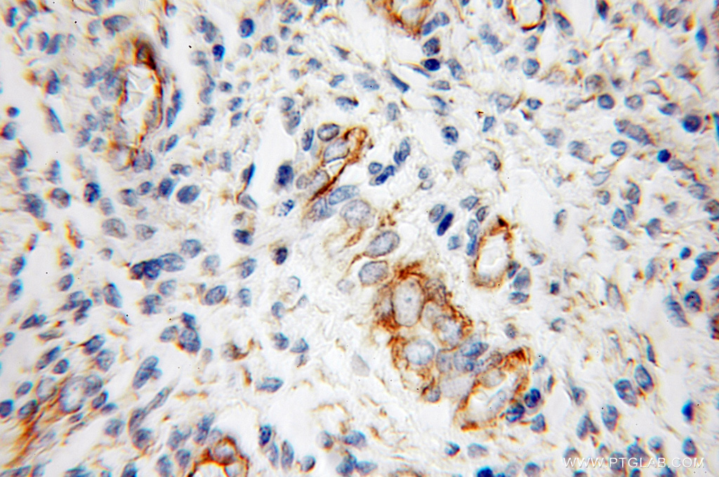 IHC staining of human endometrial cancer using 12618-1-AP