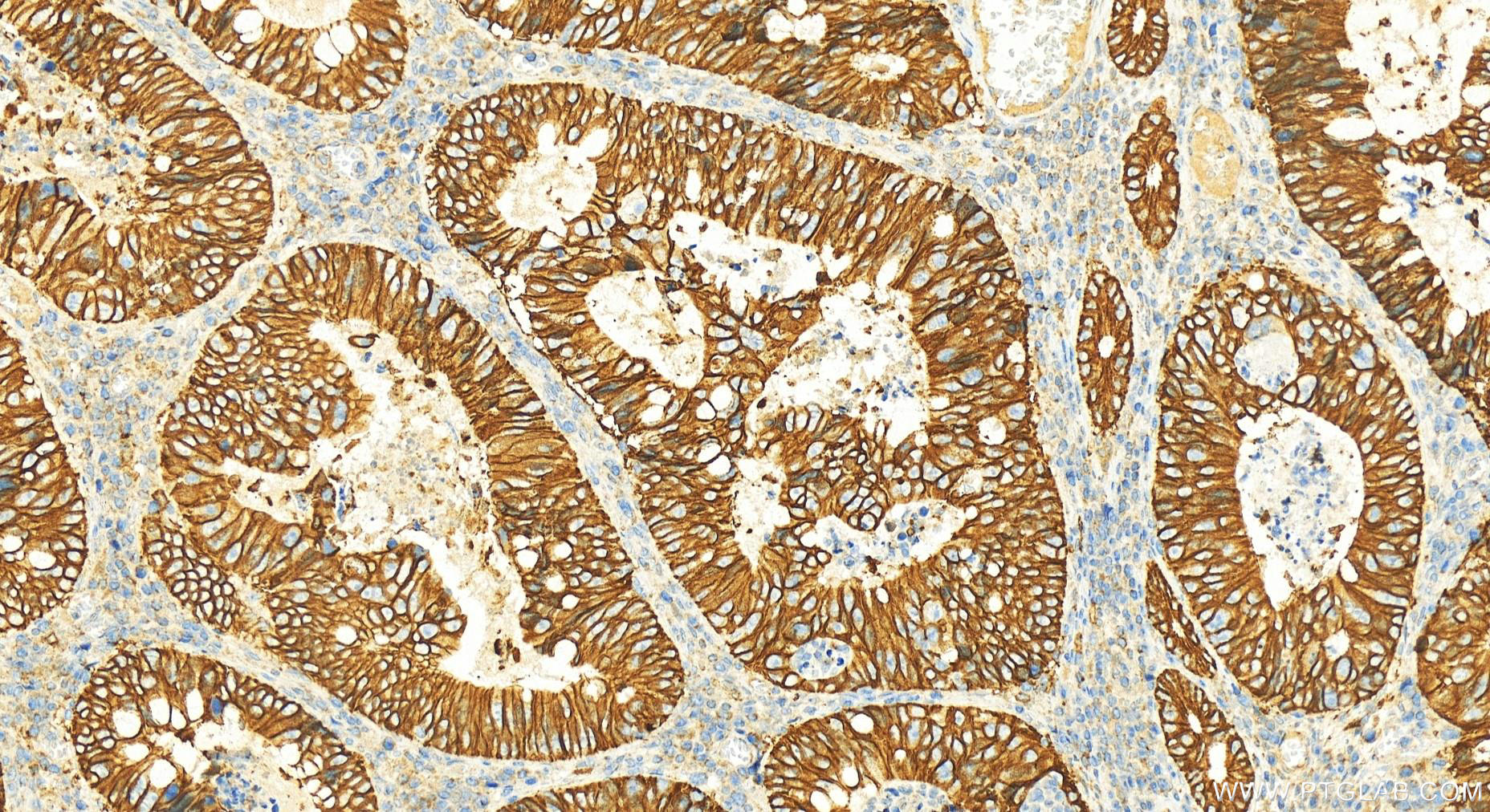 IHC staining of human colon cancer using 24339-1-AP