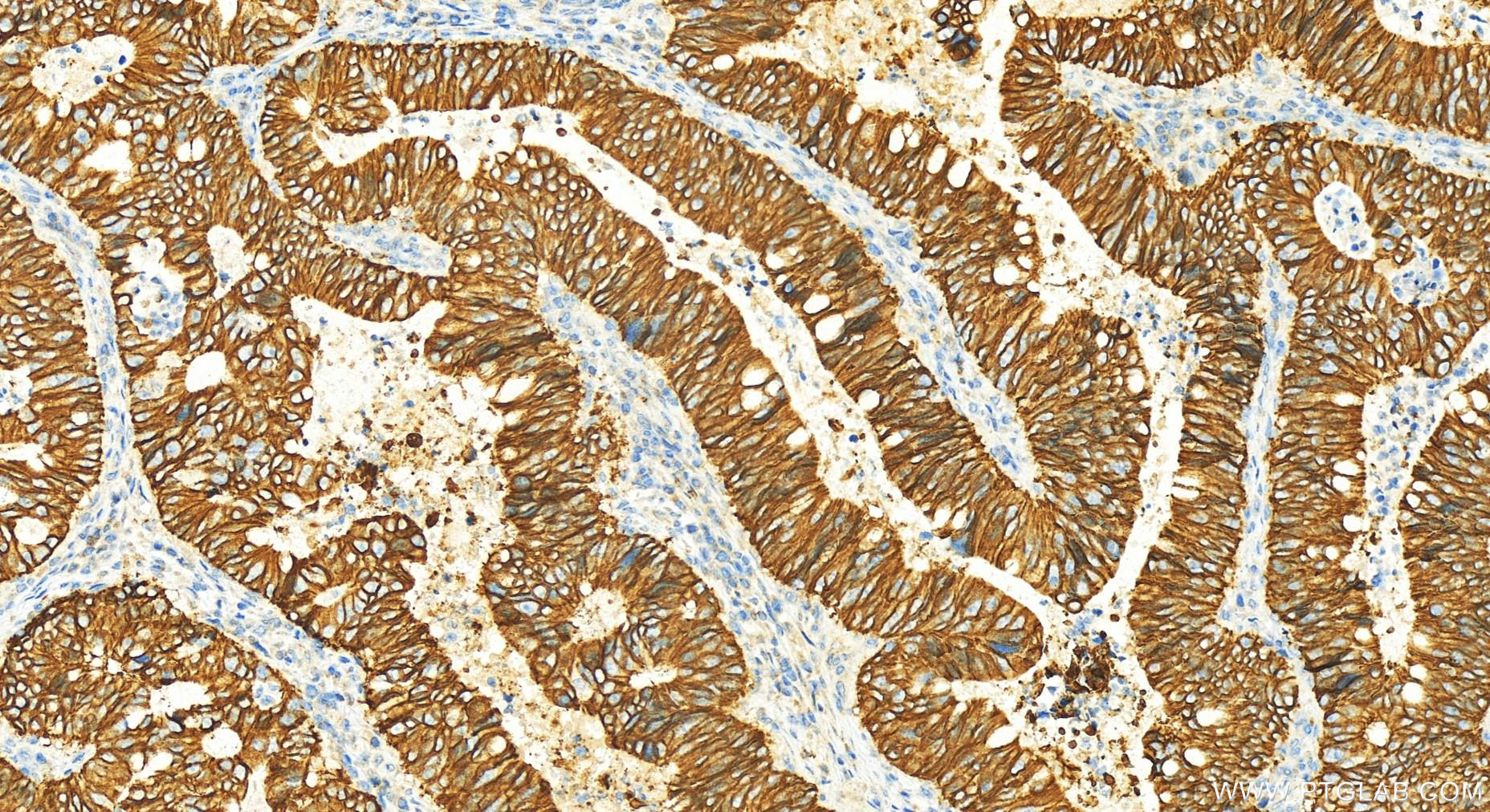 IHC staining of human colon cancer using 24339-1-AP
