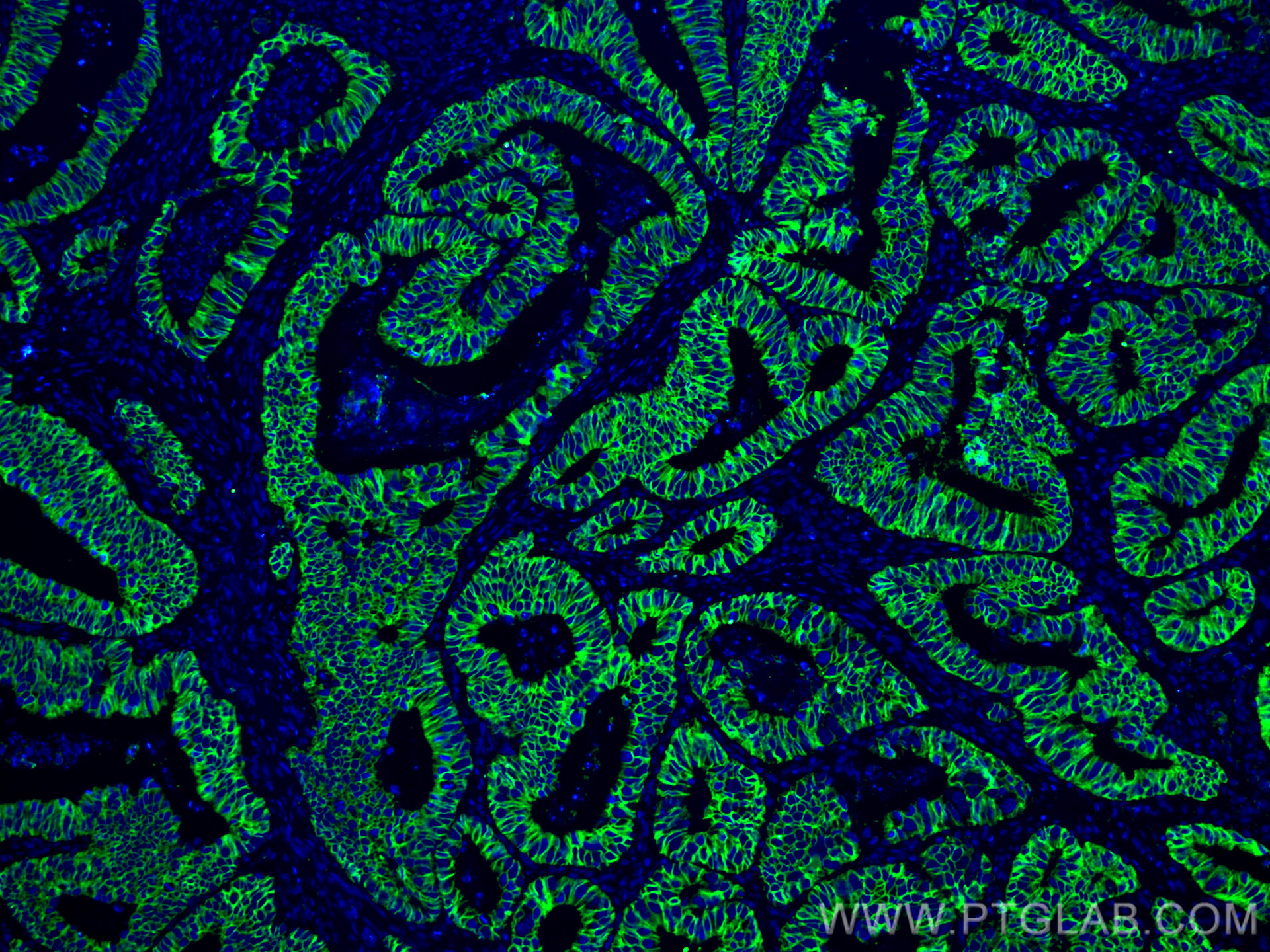 IF Staining of human colon cancer using 60351-1-Ig (same clone as 60351-1-PBS)