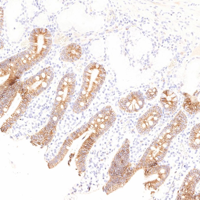 IHC staining of human stomach cancer using 60351-1-Ig