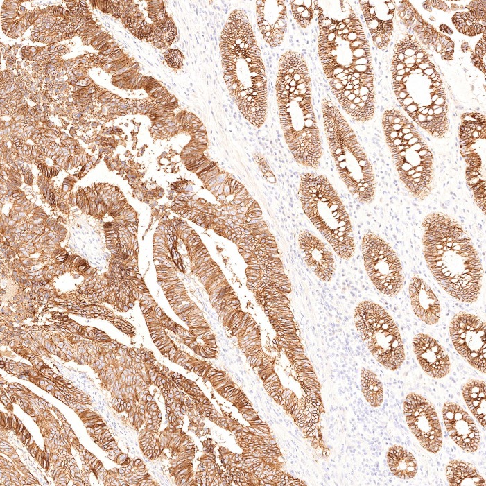 IHC staining of human colorectal cancer using 60351-1-Ig