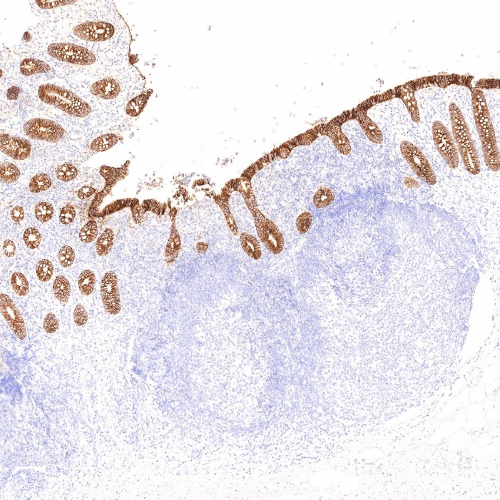 IHC staining of human appendicitis using 60351-1-Ig