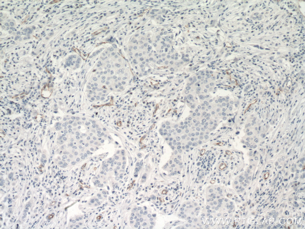 IHC staining of human breast cancer using 66804-1-Ig (same clone as 66804-1-PBS)