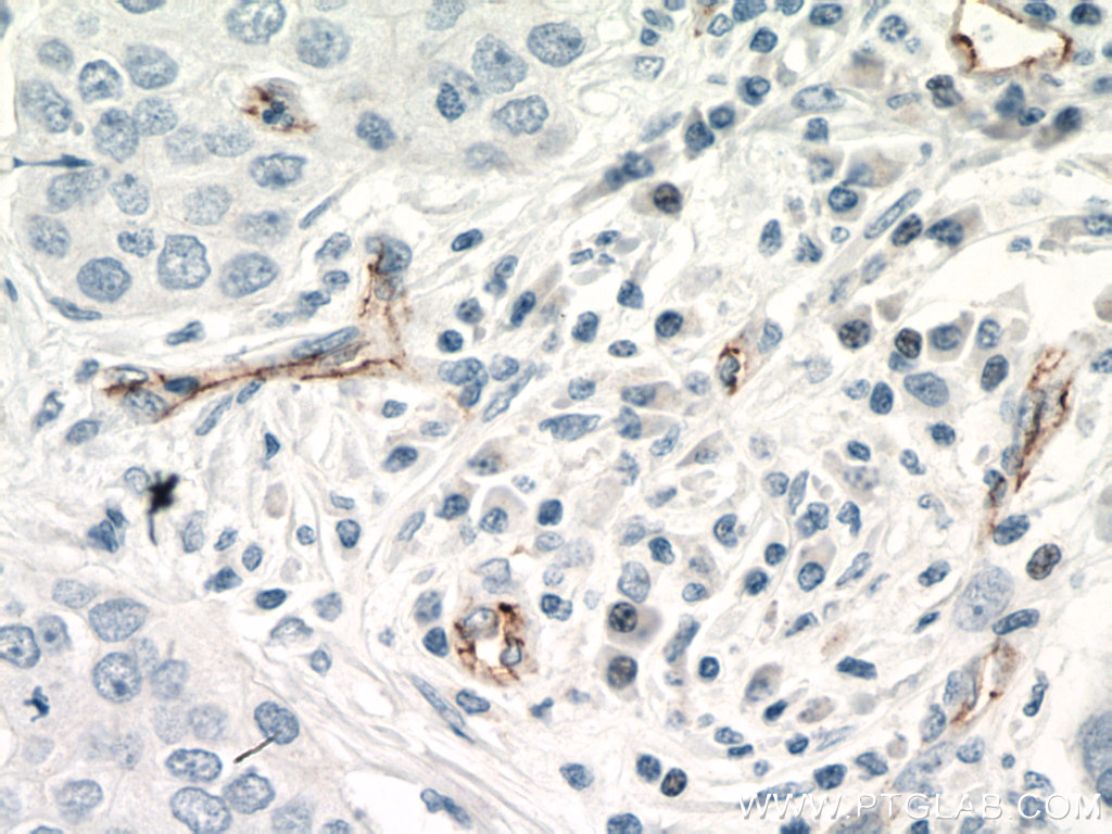 IHC staining of human breast cancer using 66804-1-Ig (same clone as 66804-1-PBS)