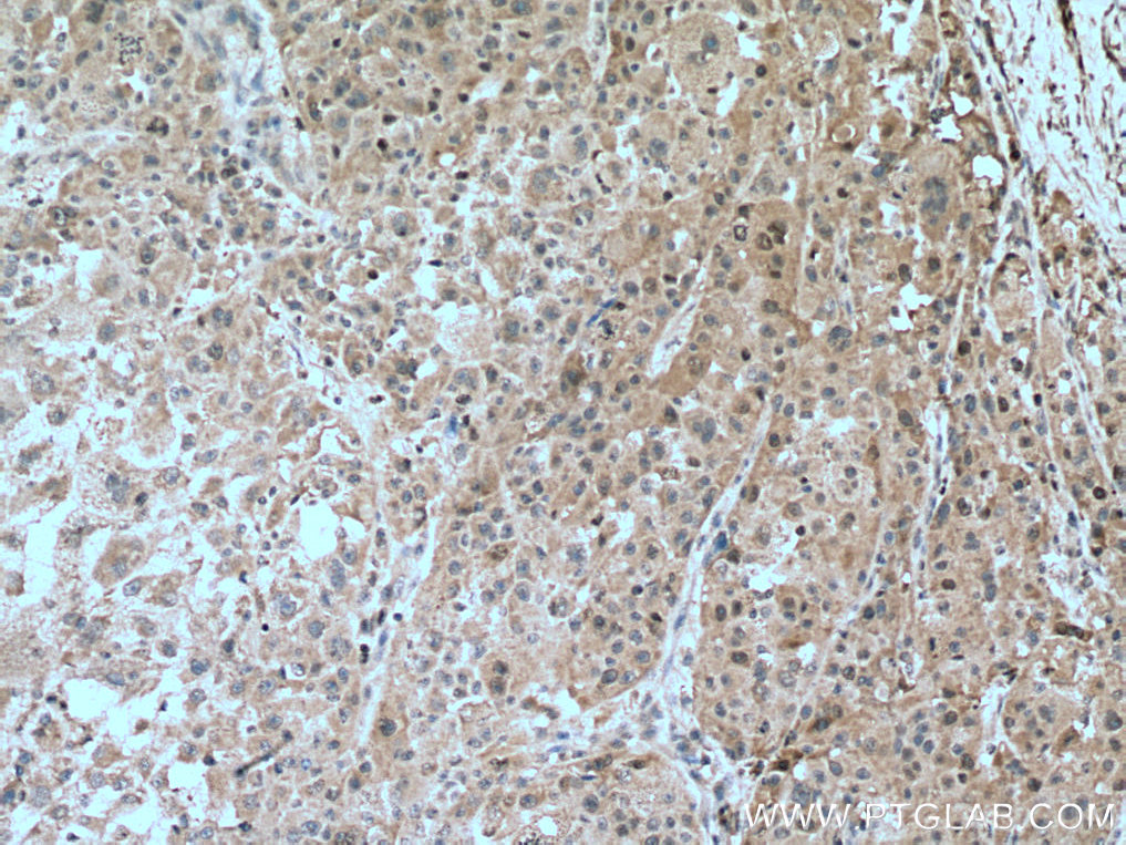 IHC staining of human liver cancer using 10122-1-AP