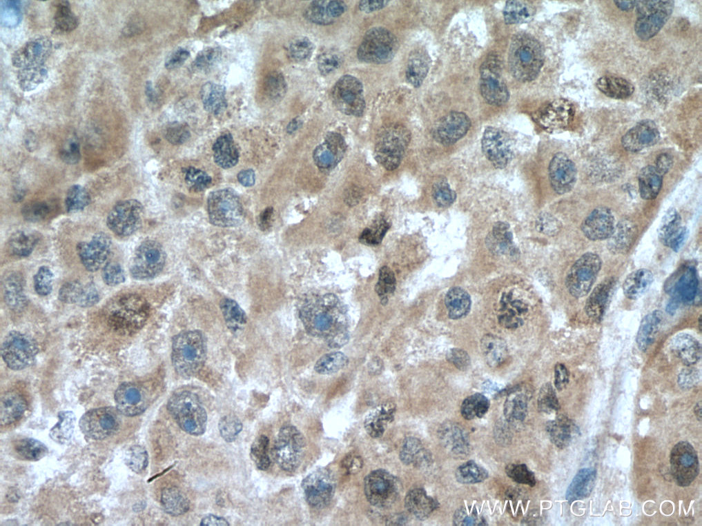 IHC staining of human liver cancer using 10122-1-AP