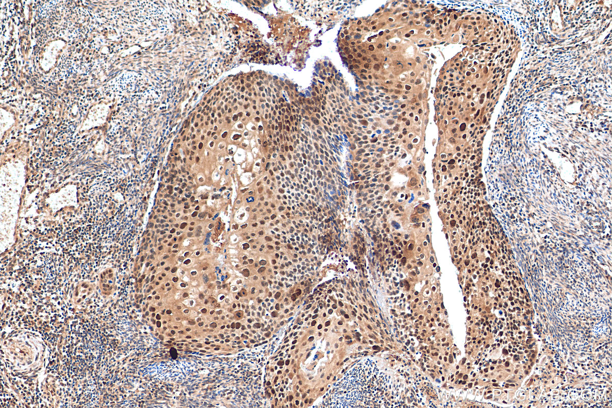 IHC staining of human cervical cancer using 22060-1-AP