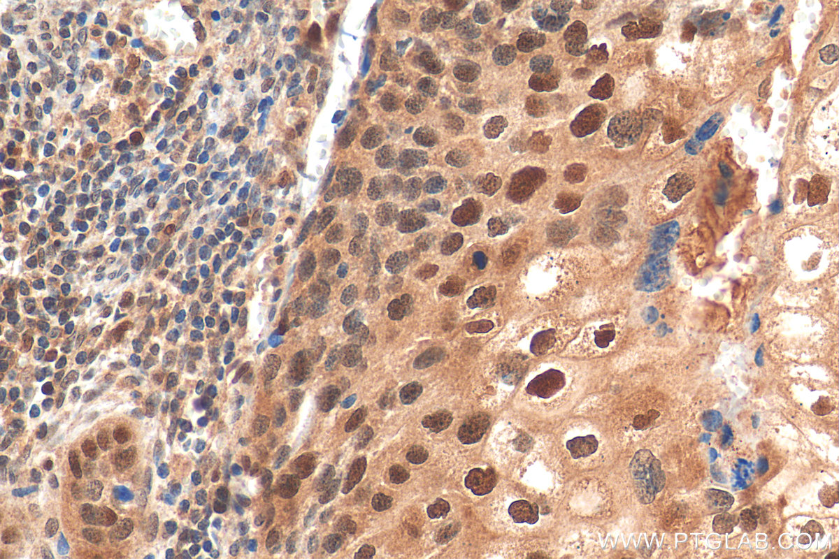 IHC staining of human cervical cancer using 22060-1-AP