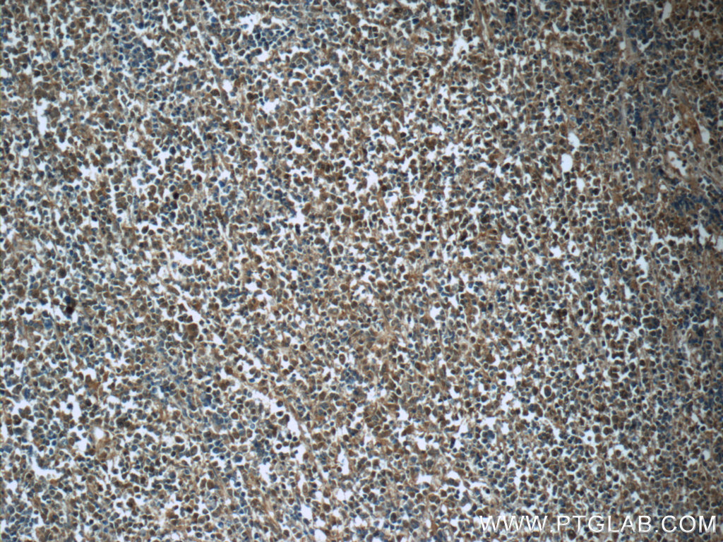 IHC staining of human lymphoma using 60312-1-Ig (same clone as 60312-1-PBS)