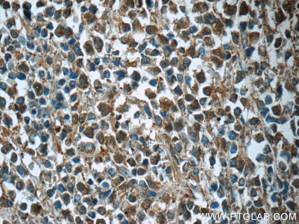 IHC staining of human lymphoma using 60312-1-Ig
