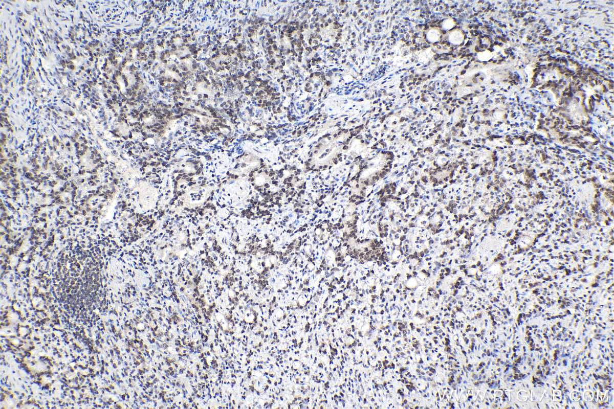 IHC staining of human stomach cancer using 15423-1-AP