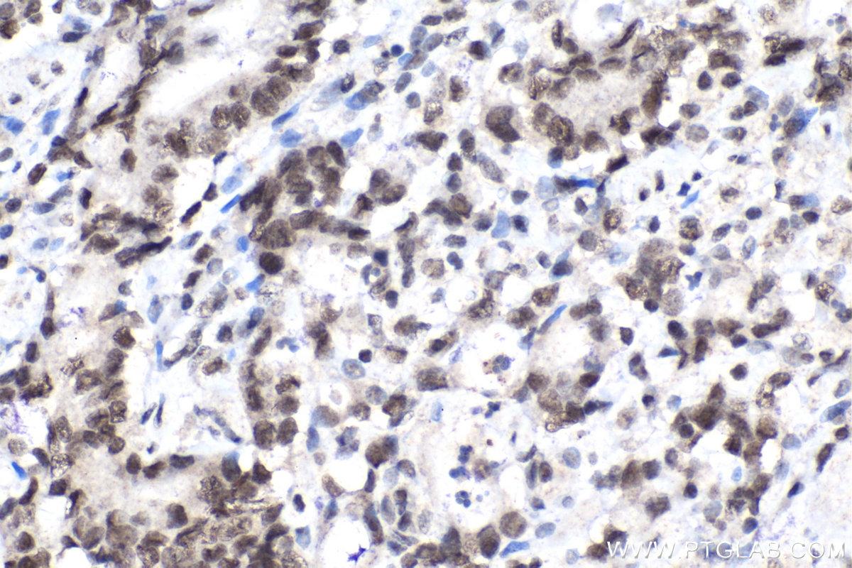 IHC staining of human stomach cancer using 15423-1-AP