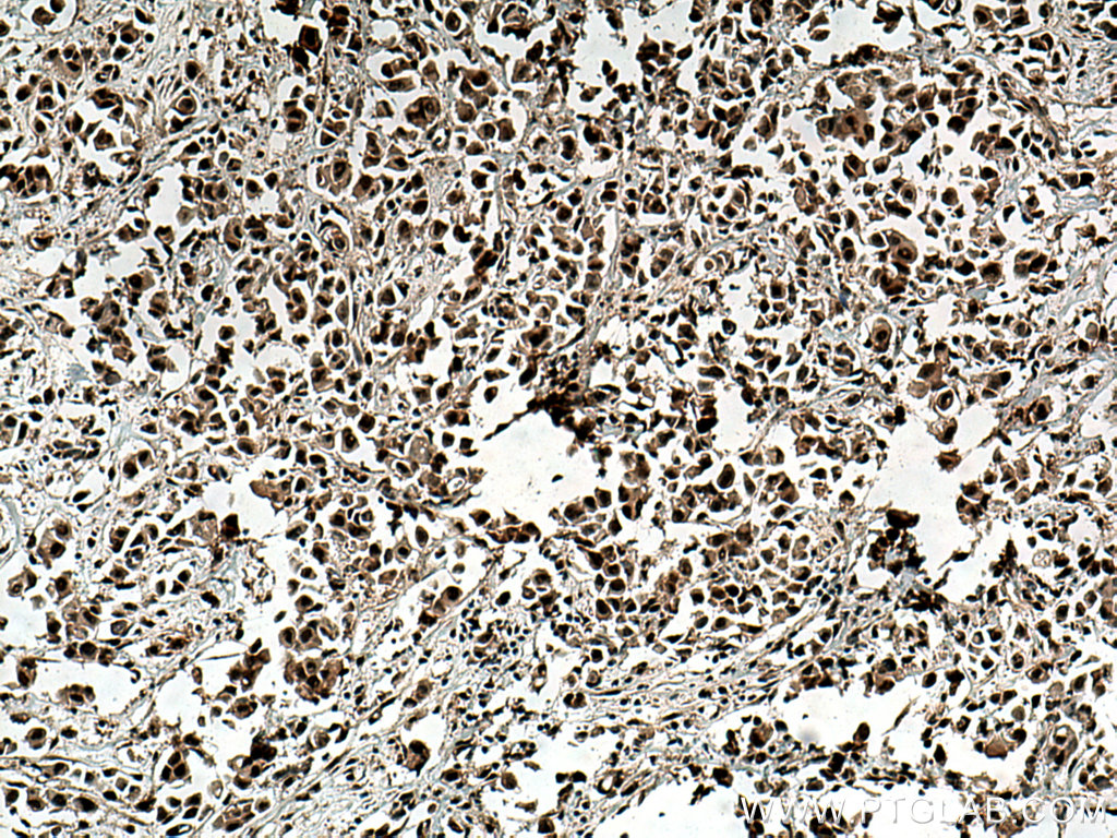 IHC staining of human breast cancer using 66950-1-Ig