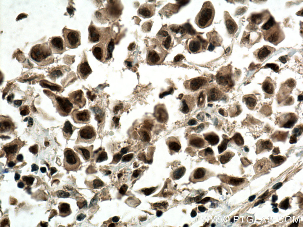 IHC staining of human breast cancer using 66950-1-Ig