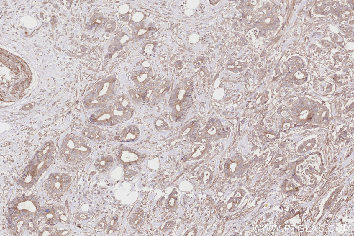 IHC staining of human rectal cancer using 31702-1-AP IHC staining of human rectal cancer using 31702-1-AP