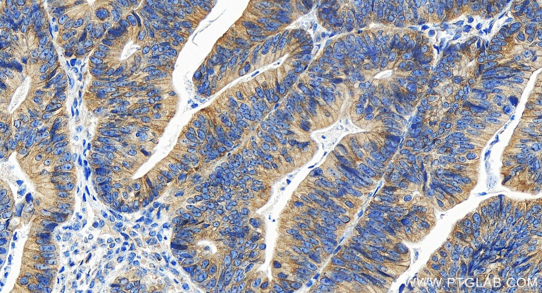 IHC staining of human colon cancer using 86177-2-RR