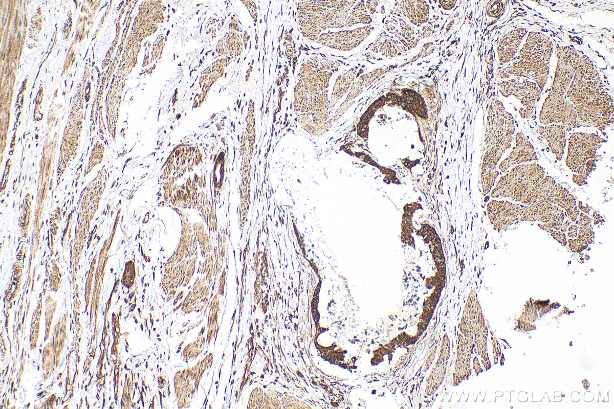 IHC staining of human urothelial carcinoma using 14052-1-AP