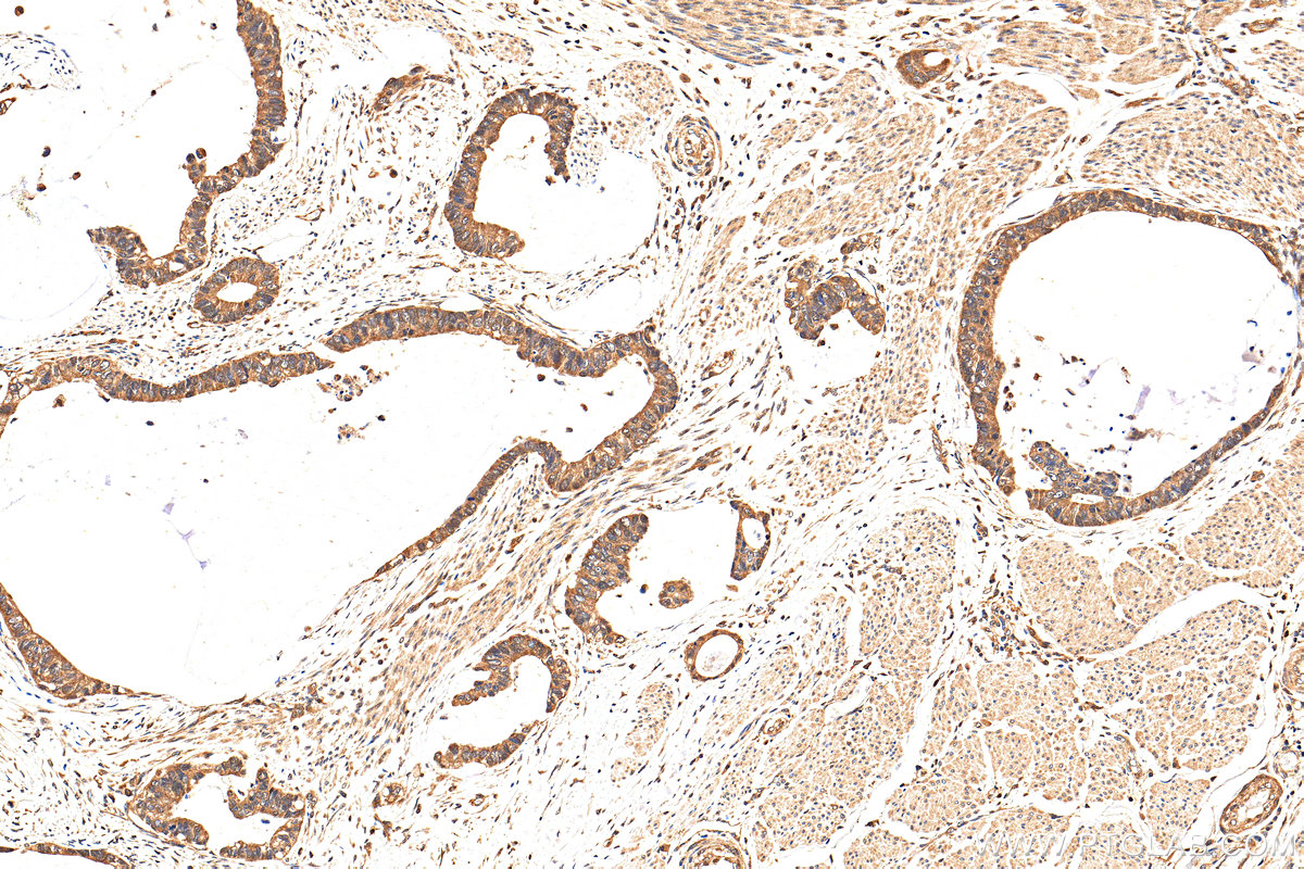 IHC staining of human urothelial carcinoma using 14052-1-AP