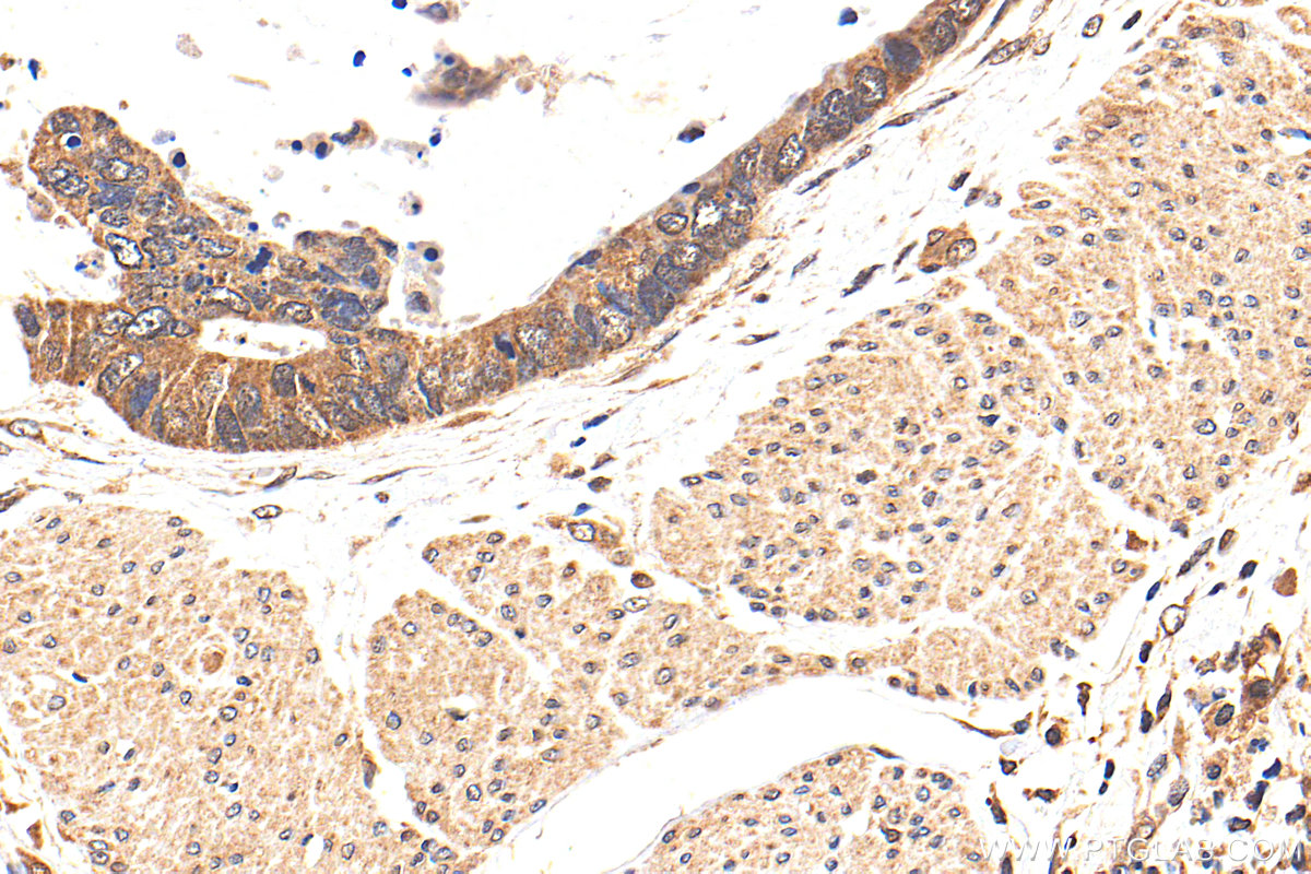 IHC staining of human urothelial carcinoma using 14052-1-AP