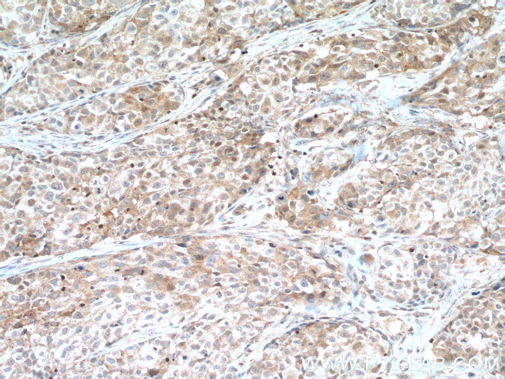 IHC staining of human lung cancer using 19117-1-AP