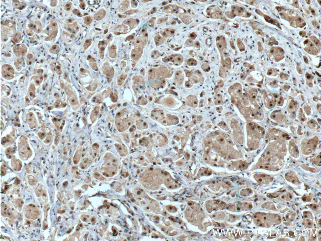 IHC staining of human breast cancer using 27027-1-AP