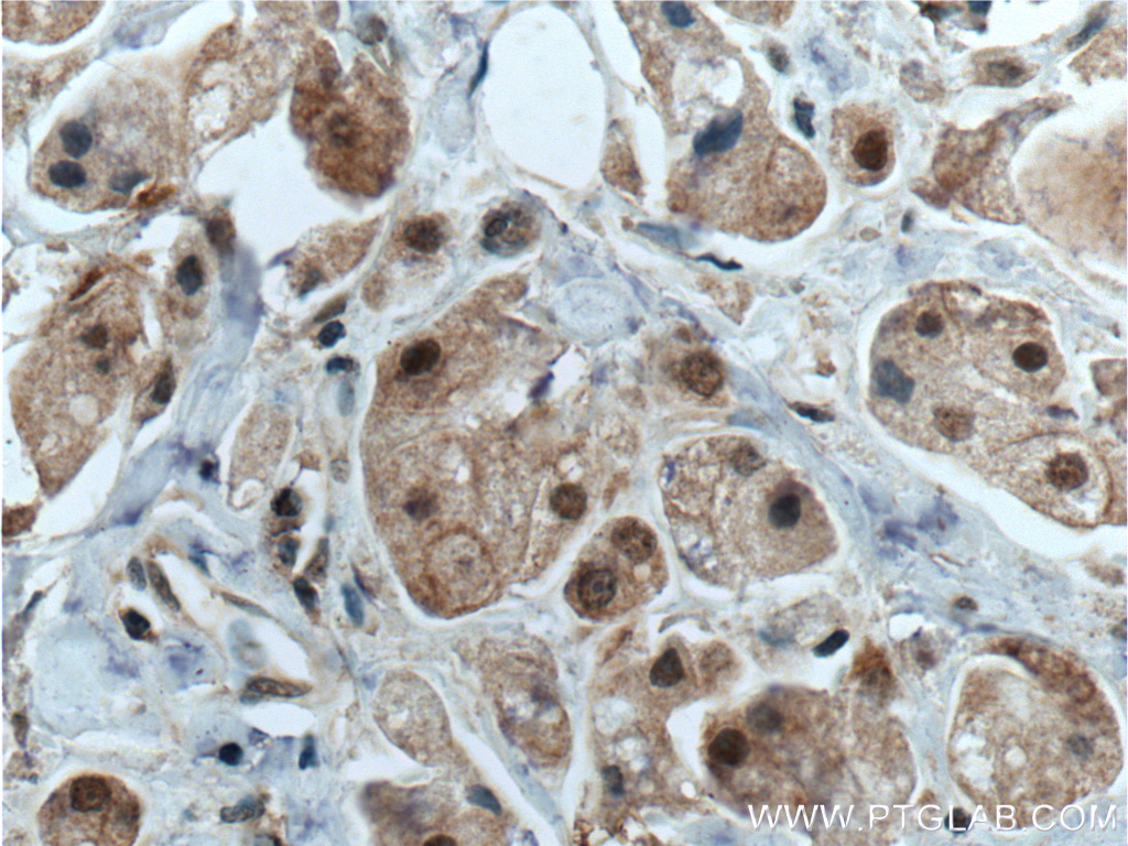 IHC staining of human breast cancer using 27027-1-AP
