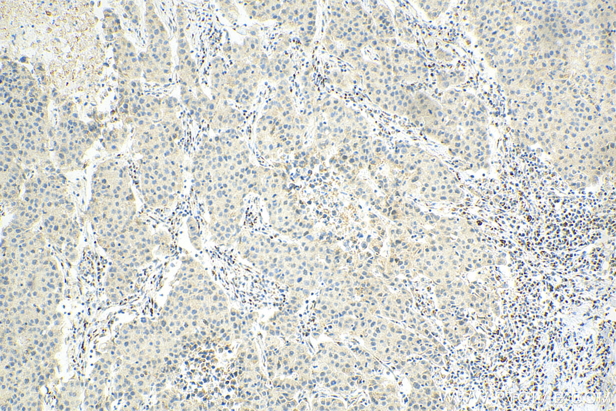 IHC staining of human breast cancer using 67889-1-Ig