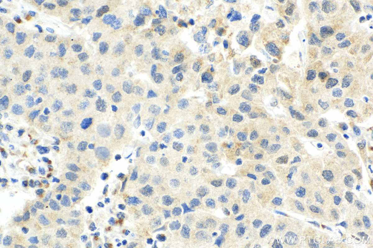 IHC staining of human breast cancer using 67889-1-Ig
