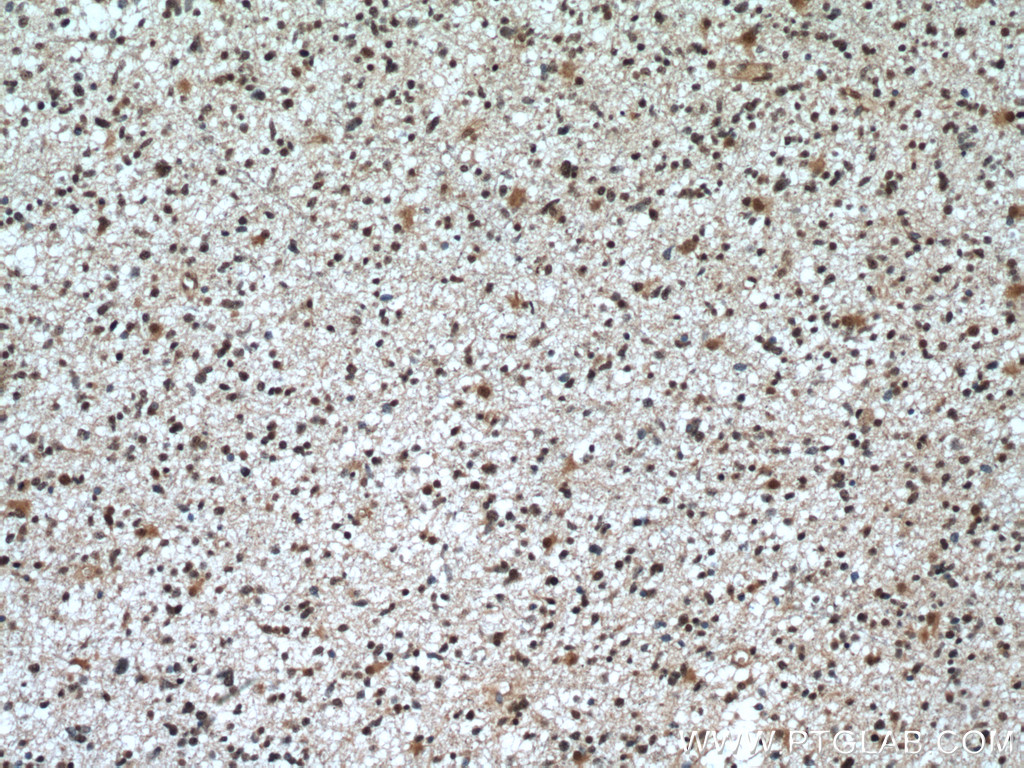 IHC staining of human gliomas using 11705-1-AP