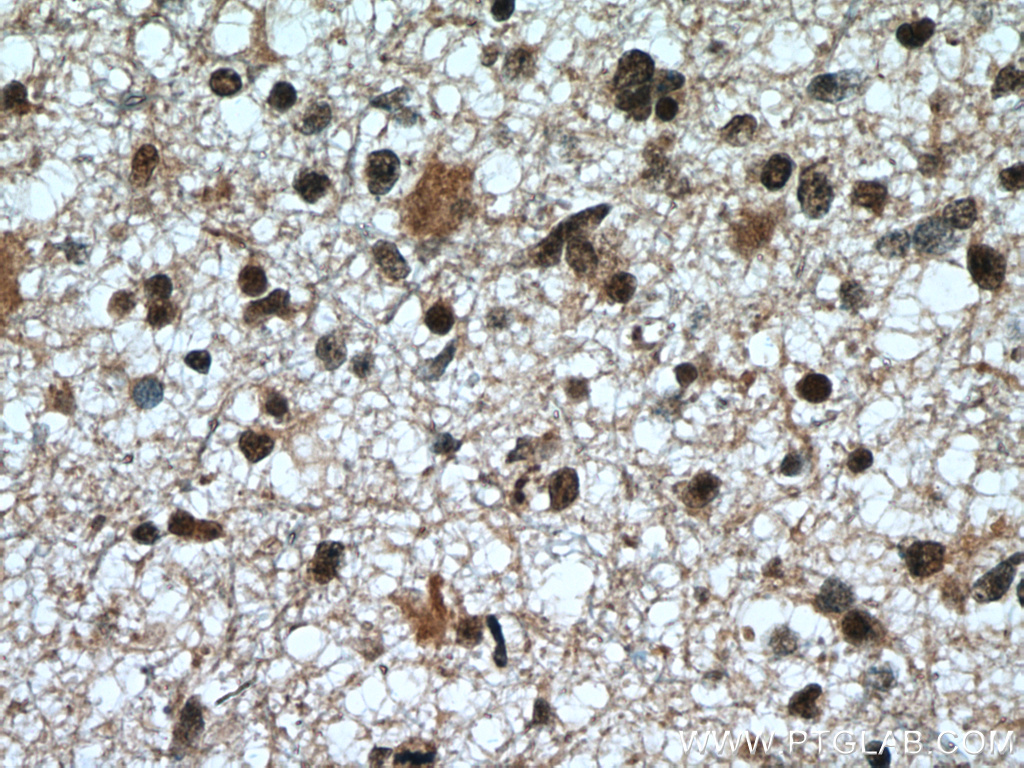 IHC staining of human gliomas using 11705-1-AP