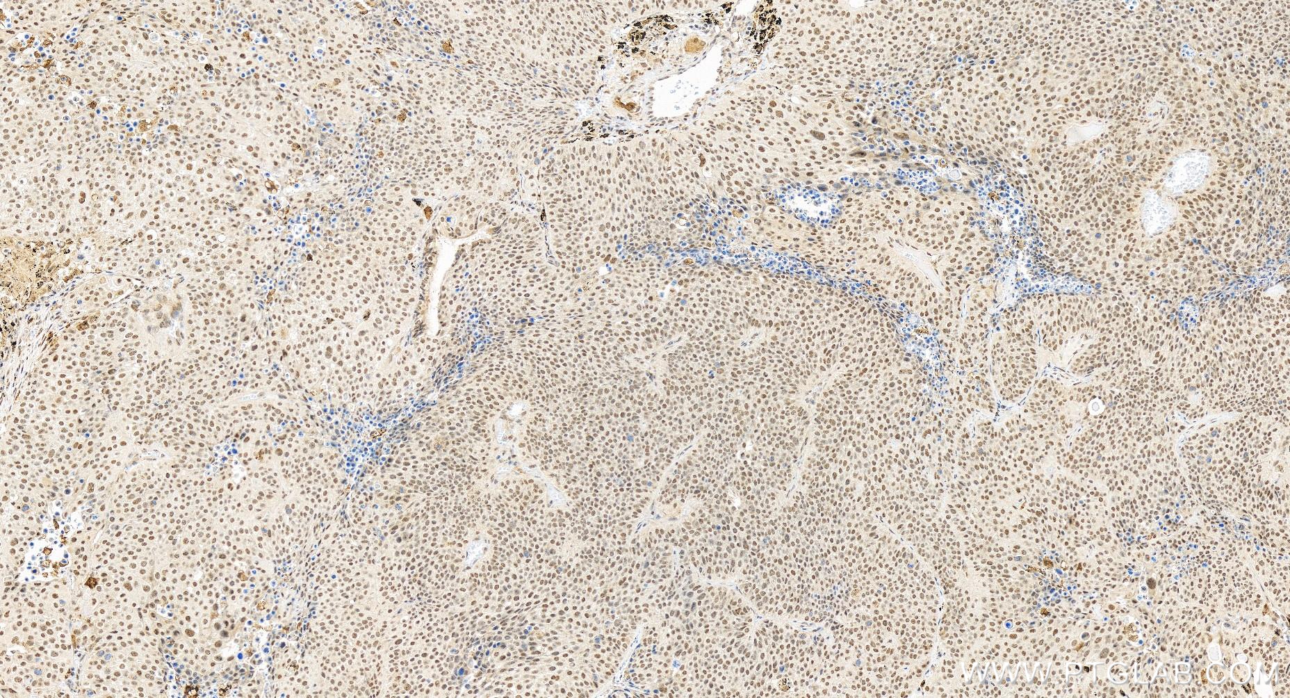 IHC staining of human lung cancer using 83662-2-RR (same clone as 83662-2-PBS)