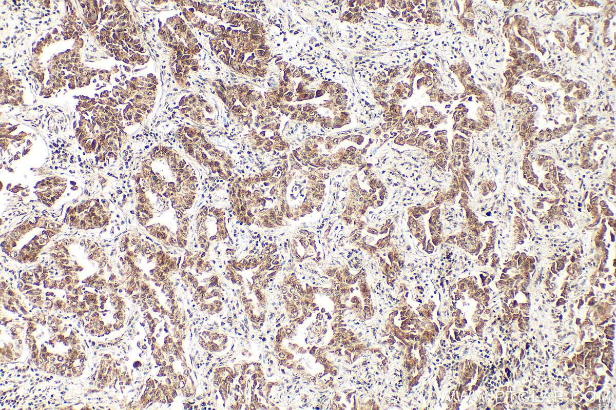 IHC staining of human lung cancer using RMX00056