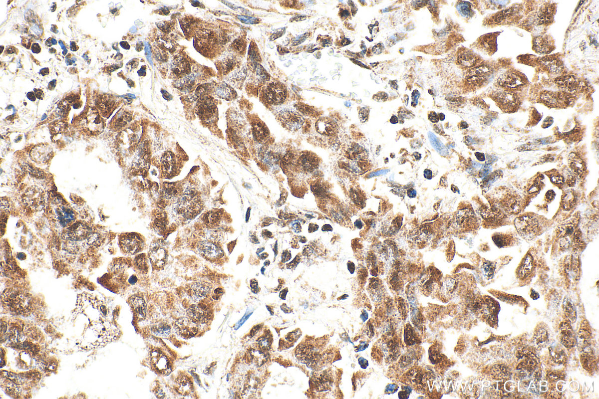 IHC staining of human lung cancer using RMX00056